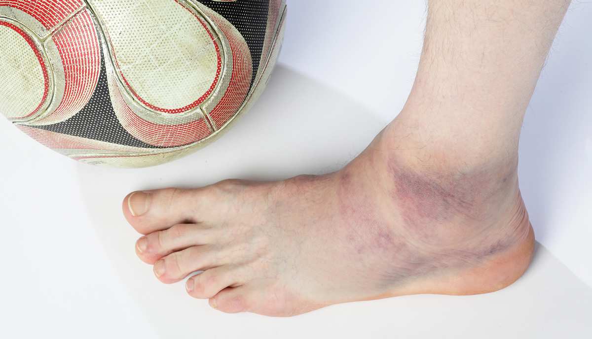 Wie Lange Dauert Eine Prellung Am Schienbein prellung.behandeln.de
